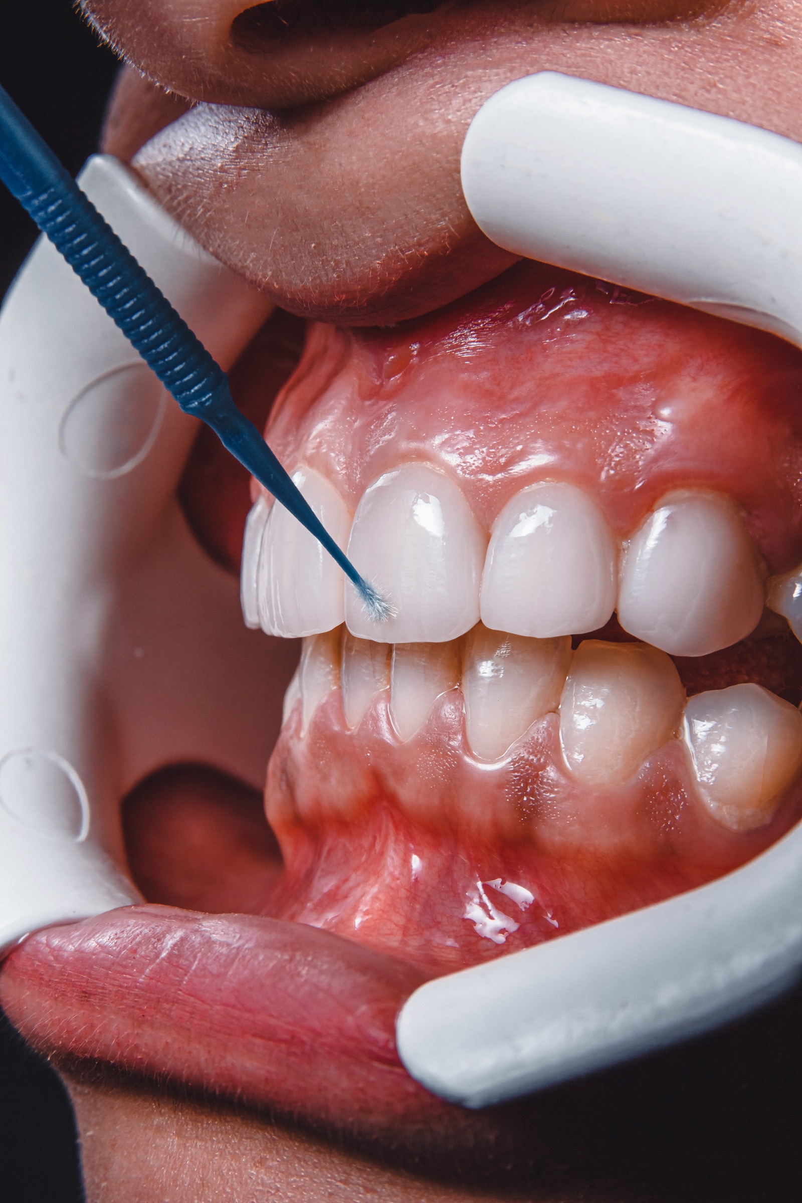 Cosmetic bonding