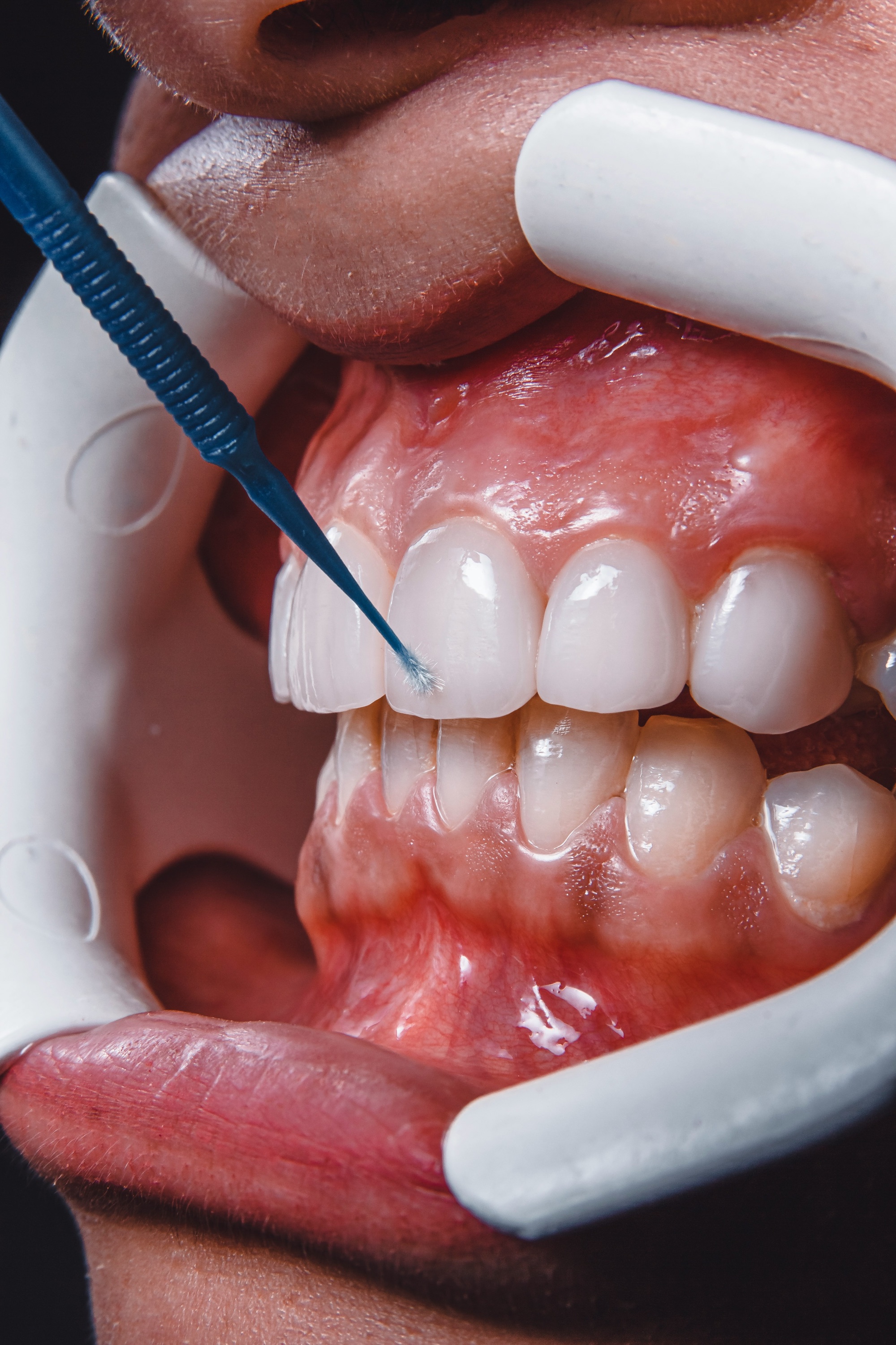 Dental implants