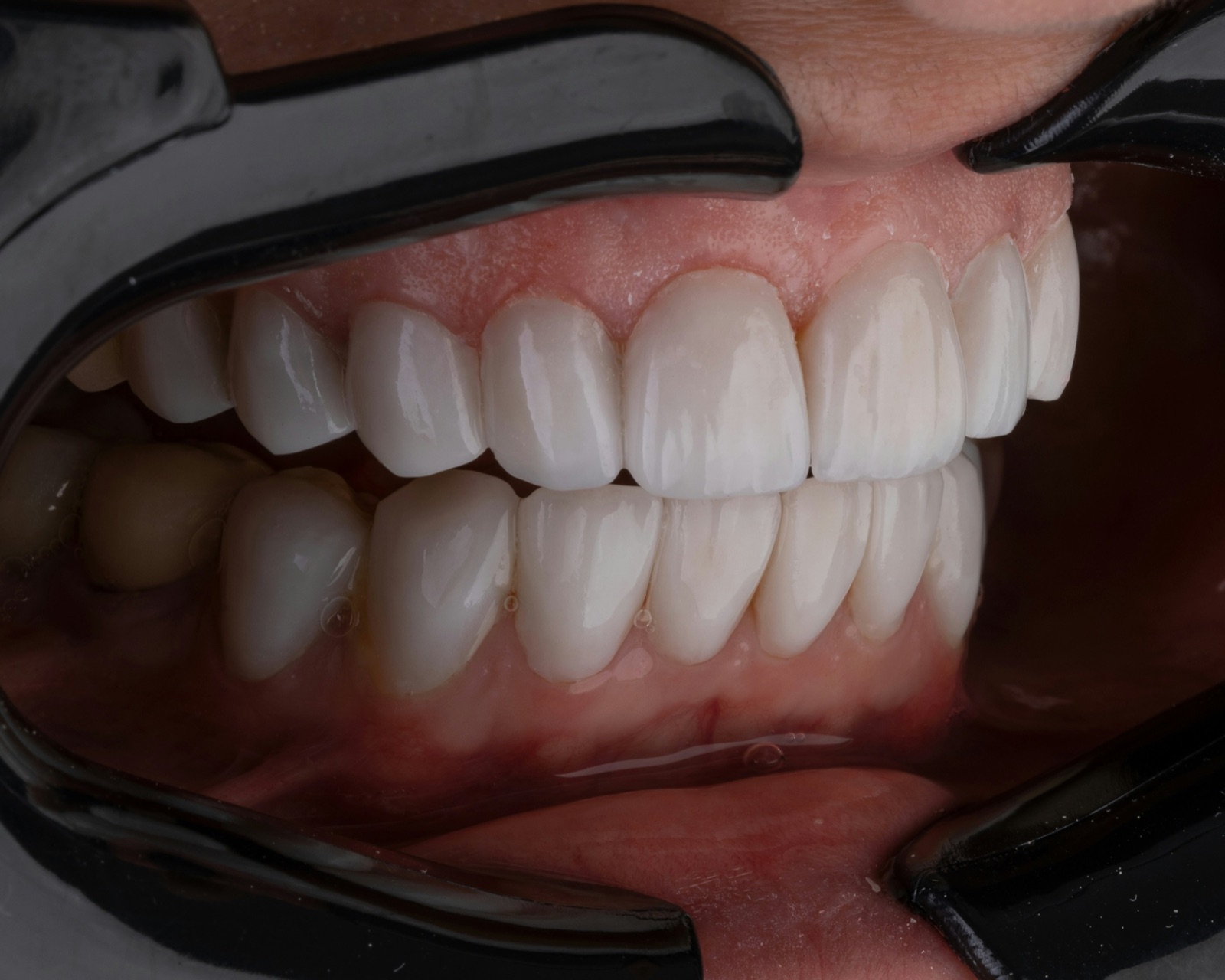 Composite veneers