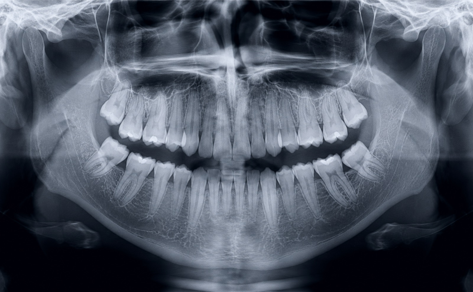 Dental X‑rays