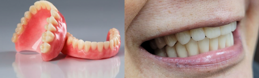 Cambie Dental Center full upper denture patient with a brand new smile