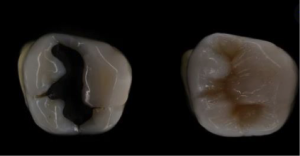Cambie Dental Composite Fillings 1 Cambie Dental Composite Fillings 1