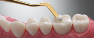 Cambie Dental Composite Fillings 2