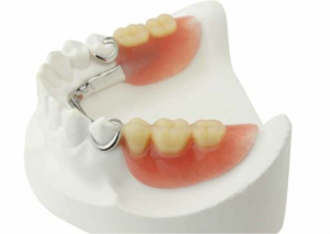 Cambie Dental Partial Denture