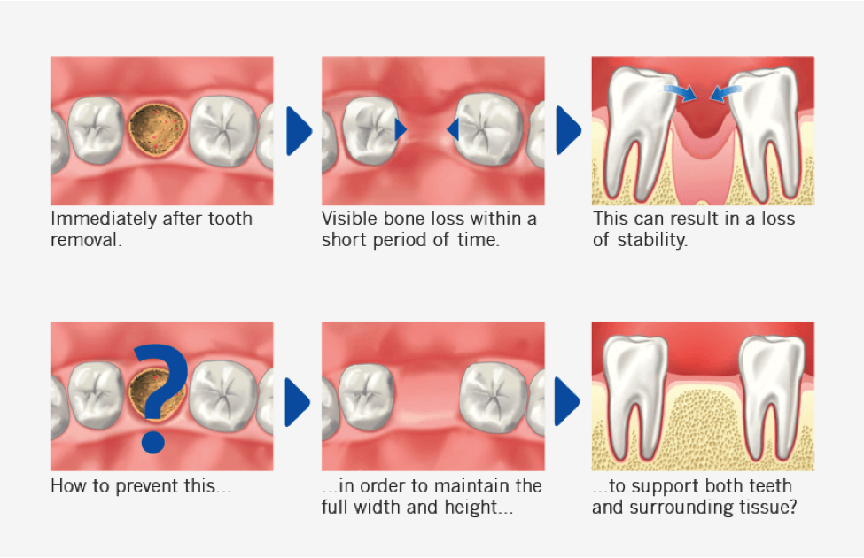 Cambie Dental bone grafting