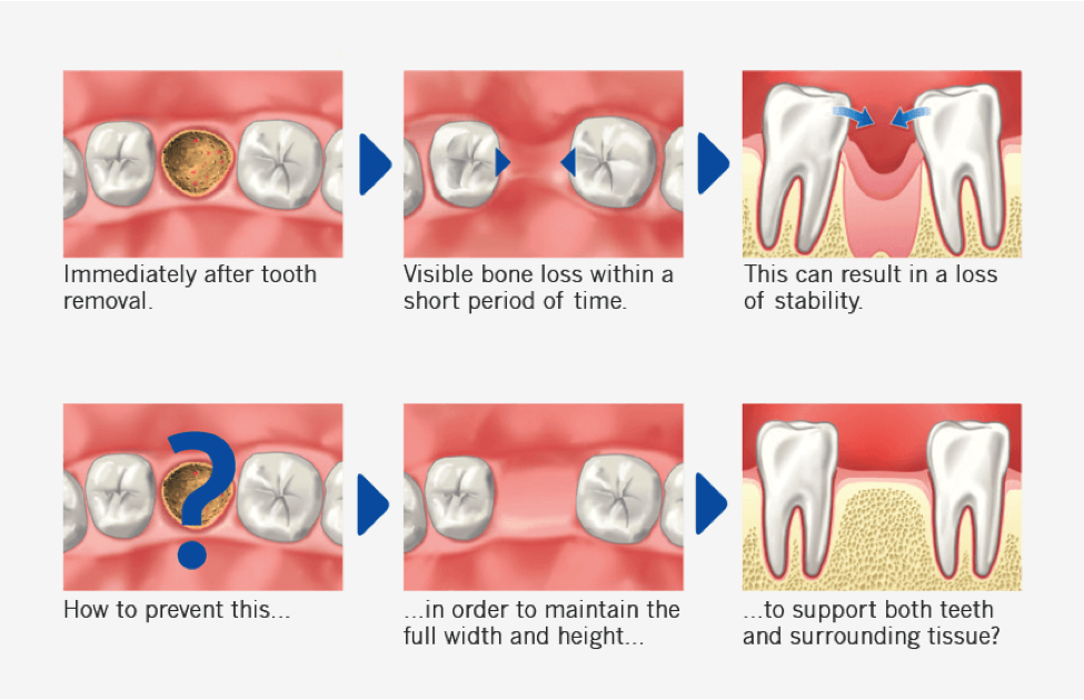 Cambie Dental bone grafting Cambie Dental bone grafting