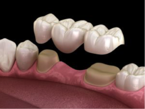 Cambie Dental Bridge