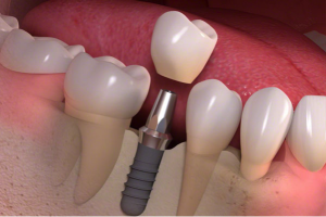 Cambie Dental Single or Multiple Dental Implants
