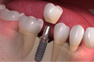 Cambie Dental Single or Multiple Dental Implants Cambie Dental Single or Multiple Dental Implants