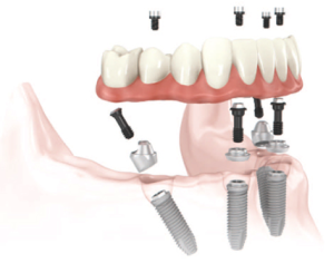 Cambie Dental Full Arch Fixed Dental Implant Therapy