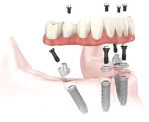 Cambie Dental Full Arch Fixed Dental Implant Therapy Cambie Dental Full Arch Fixed Dental Implant Therapy
