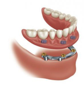 Cambie Dental Implant Supported Denture