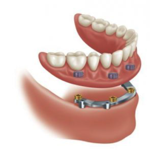 Cambie Dental Implant Supported Denture Cambie Dental Implant Supported Denture