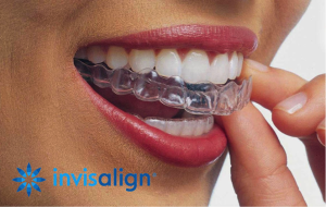 Cambie Dental Clear Aligners and Invisalign