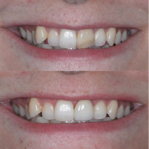 Cambie Dental Porcelain Veneers