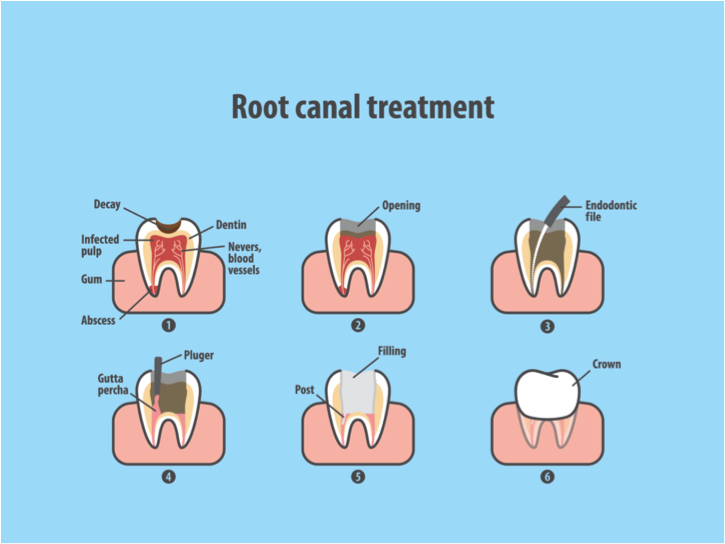 Cambie Dental Root Canal Treatment