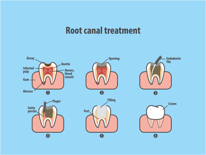 Cambie Dental Root Canal Treatment Cambie Dental Root Canal Treatment