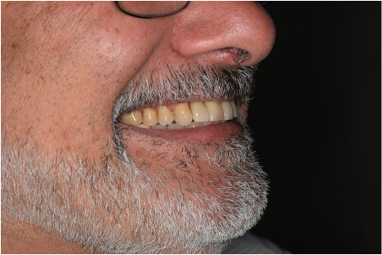 Cambie Dental Immediate Tooth in a Day 4 Month Final Results Cambie Dental Immediate Tooth in a Day 4 Month Final Results