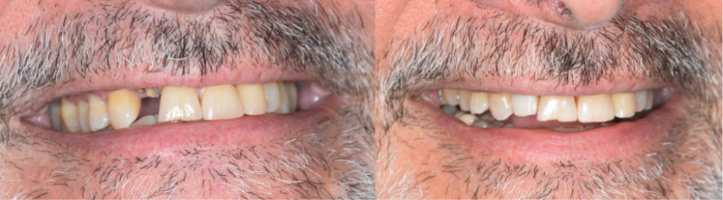 Cambie Dental Immediate Tooth in a Day Cambie Dental Immediate Tooth in a Day