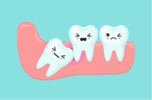 Cambie Dental Wisdom Teeth Extraction